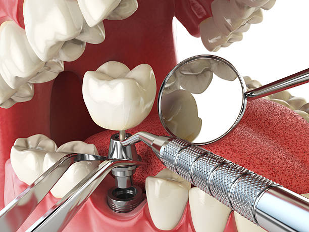 Best Knocked-Out Tooth Emergency  in Rogers, TX